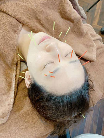 美容鍼施術の写真